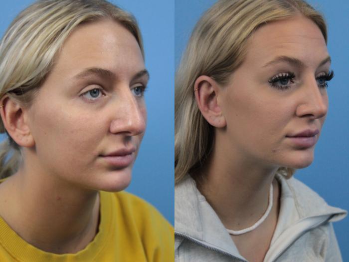 Before & After Rhinoplasty Case 214 Right Oblique View in West Des Moines & Ames, IA