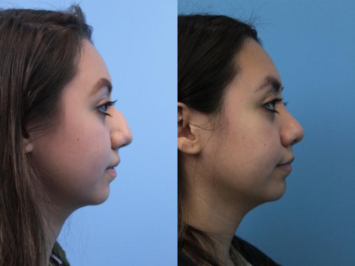 Before & After Rhinoplasty Case 215 Right Side View in West Des Moines & Ames, IA