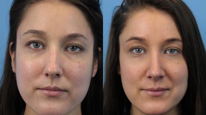 Before & After Rhinoplasty Case 221 Front View in West Des Moines & Ames, IA