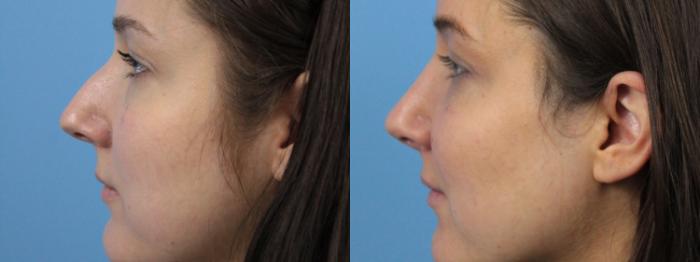 Before & After Rhinoplasty Case 221 Left Side View in West Des Moines & Ames, IA