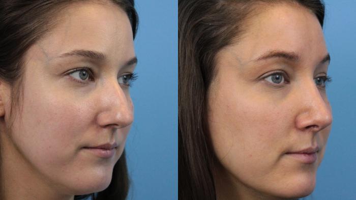 Before & After Rhinoplasty Case 221 Right Oblique View in West Des Moines & Ames, IA