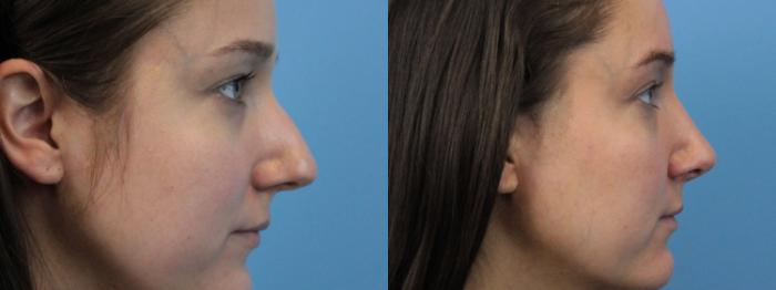 Before & After Rhinoplasty Case 221 Right Side View in West Des Moines & Ames, IA