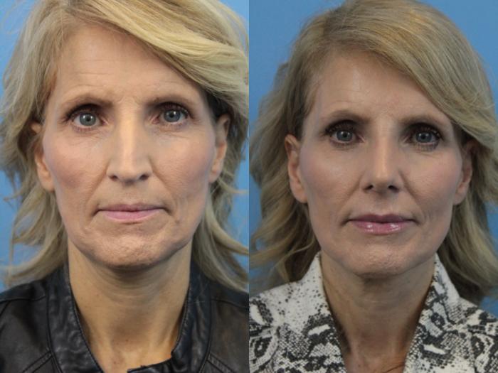 Before & After Rhinoplasty Case 225 Front View in West Des Moines & Ames, IA