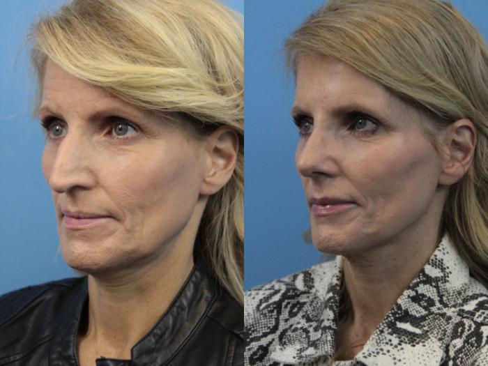 Before & After Rhinoplasty Case 225 Left Oblique View in West Des Moines & Ames, IA
