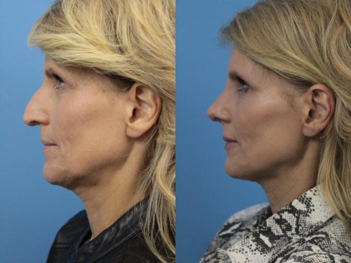 Before & After Rhinoplasty Case 225 Left Side View in West Des Moines & Ames, IA
