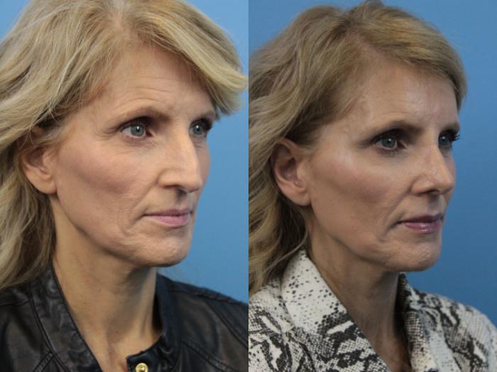 Before & After Rhinoplasty Case 225 Right Oblique View in West Des Moines & Ames, IA