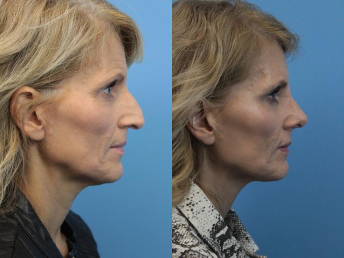 Before & After Rhinoplasty Case 225 Right Side View in West Des Moines & Ames, IA