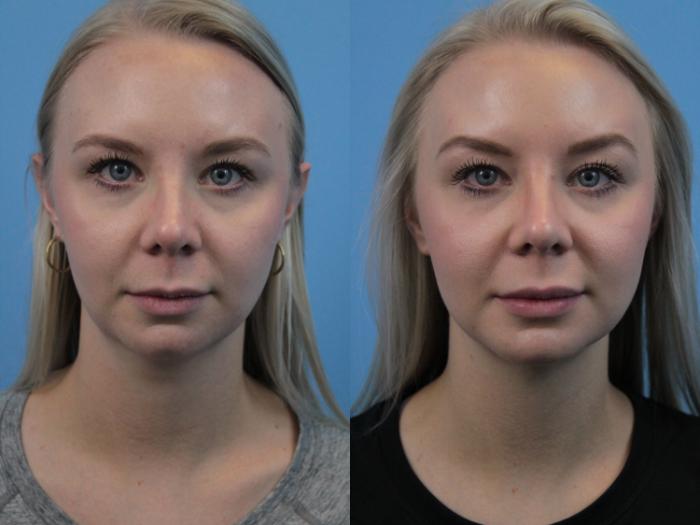Before & After Facial Liposuction Case 227 Front View in West Des Moines, IA