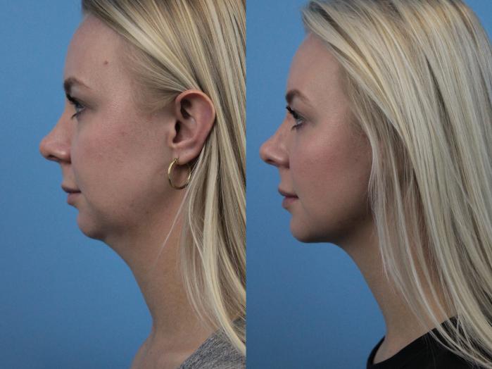 Before & After Rhinoplasty Case 227 Left Side View in West Des Moines, IA