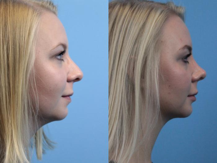 Before & After Rhinoplasty Case 227 Right Side View in West Des Moines, IA