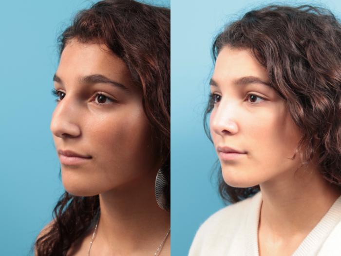 Before & After Rhinoplasty Case 23 Left Oblique View in West Des Moines & Ames, IA