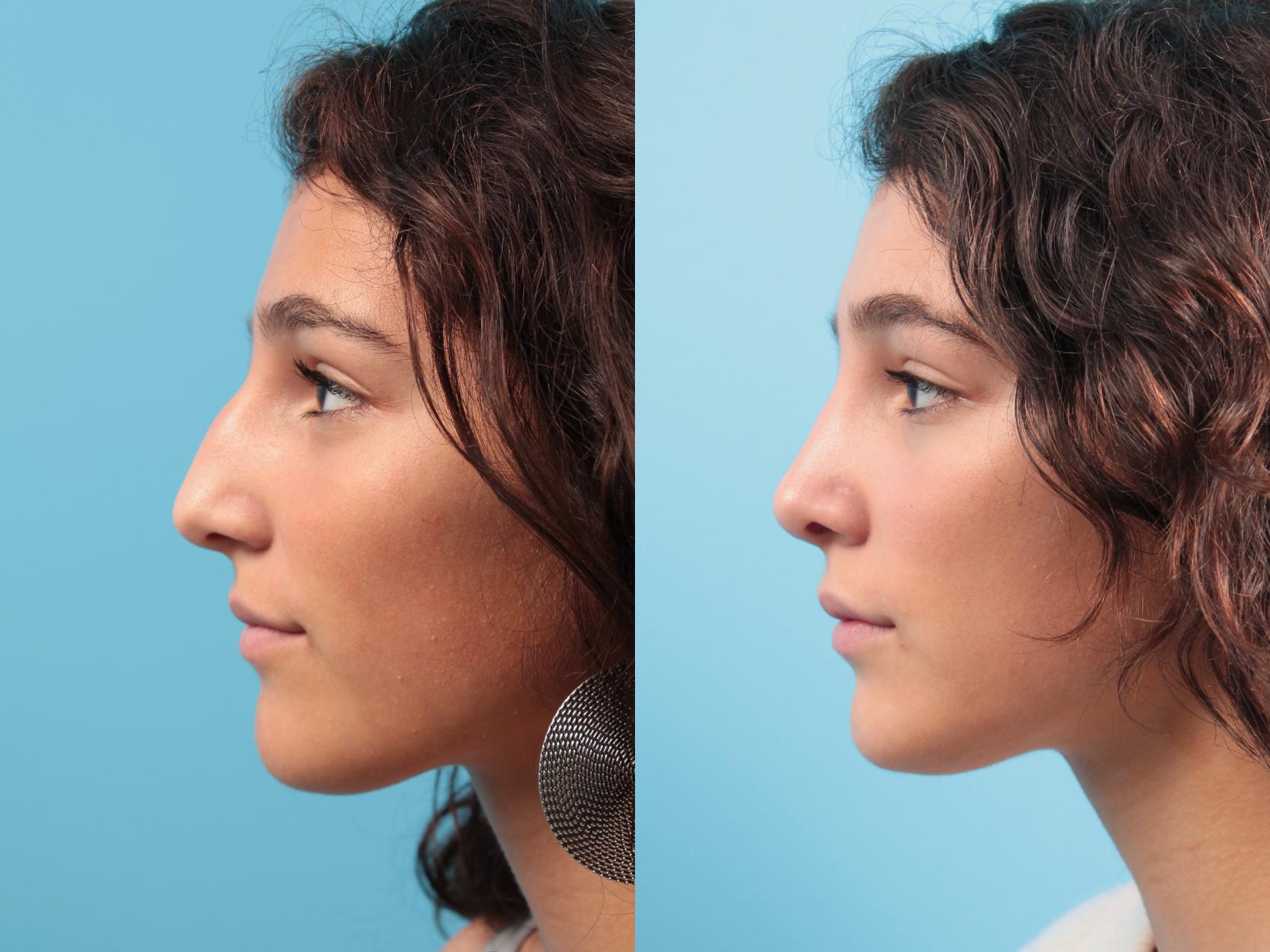 Before & After Rhinoplasty Case 23 Left Side View in West Des Moines & Ames, IA