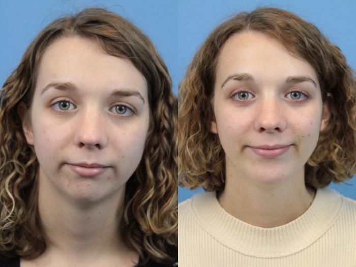 Before & After Rhinoplasty Case 235 Front View in West Des Moines & Ames, IA