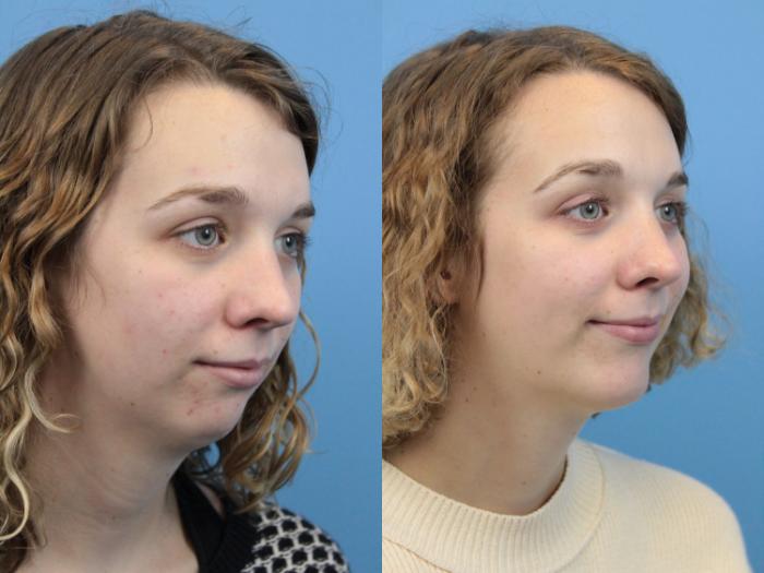Before & After Chin Augmentation Case 235 Right Oblique View in West Des Moines & Ames, IA