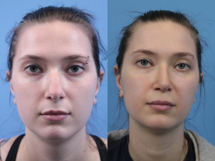 Before & After Rhinoplasty Case 237 Front View in West Des Moines & Ames, IA
