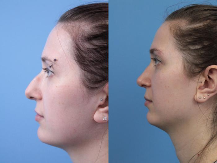 Before & After Rhinoplasty Case 237 Left Side View in West Des Moines & Ames, IA