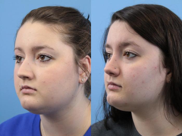 Before & After Rhinoplasty Case 238 Left Oblique View in West Des Moines & Ames, IA