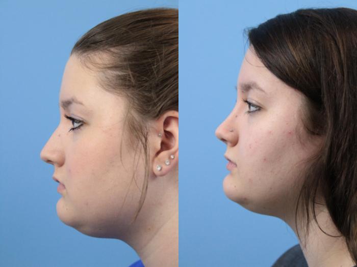 Before & After Rhinoplasty Case 238 Left Side View in West Des Moines & Ames, IA