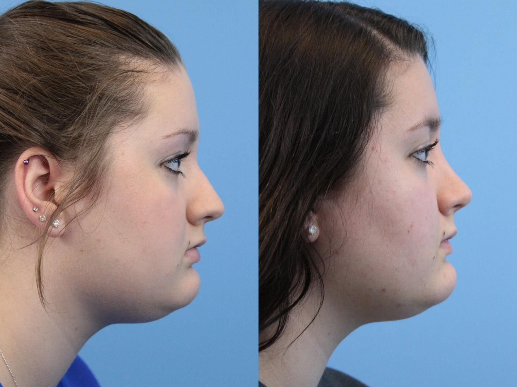Before & After Rhinoplasty Case 238 Right Side View in West Des Moines & Ames, IA
