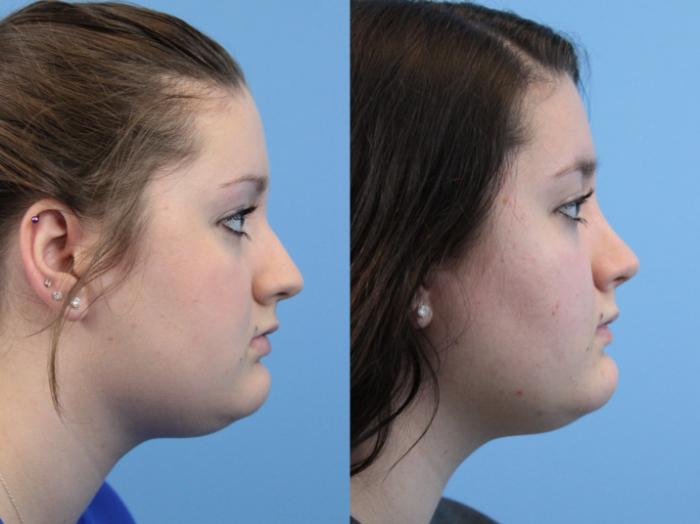 Before & After Rhinoplasty Case 238 Right Side View in West Des Moines & Ames, IA