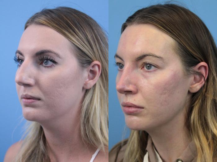 Before & After Rhinoplasty Case 240 Left Oblique View in West Des Moines & Ames, IA