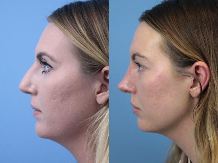 Before & After Rhinoplasty Case 240 Left Side View in West Des Moines & Ames, IA