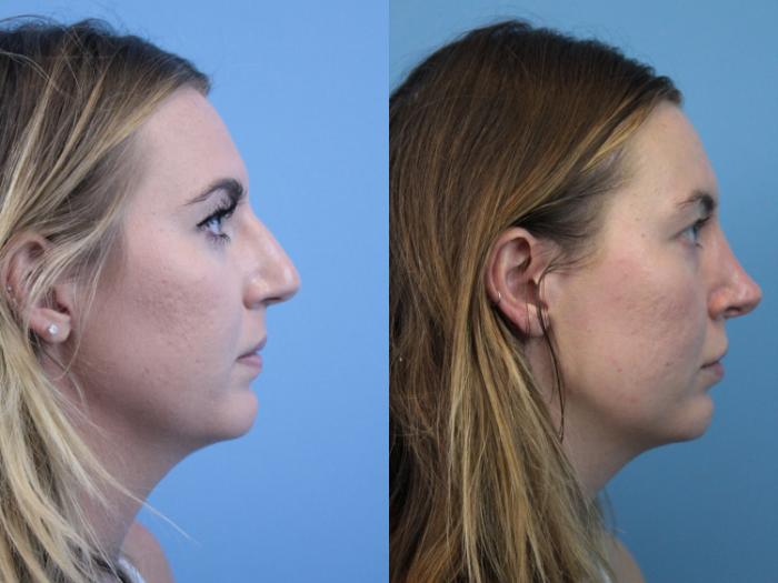 Before & After Rhinoplasty Case 240 Right Side View in West Des Moines & Ames, IA