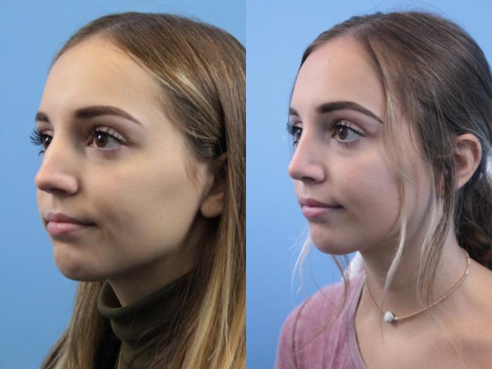 Before & After Rhinoplasty Case 241 Left Oblique View in West Des Moines & Ames, IA