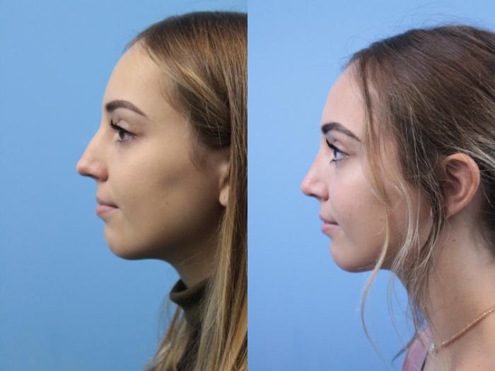 Before & After Rhinoplasty Case 241 Left Side View in West Des Moines & Ames, IA