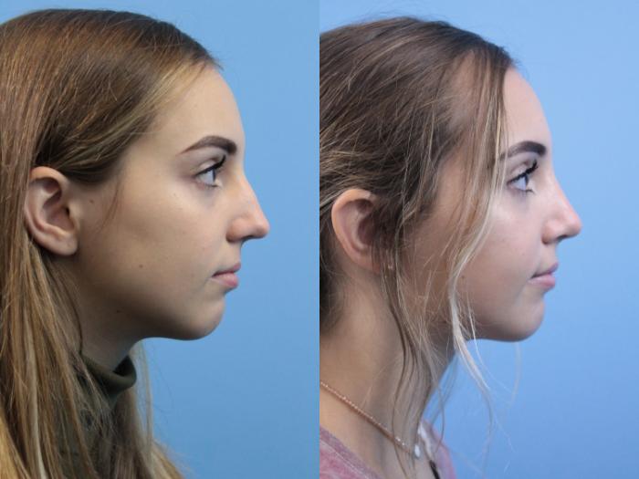 Before & After Rhinoplasty Case 241 Right Side View in West Des Moines & Ames, IA