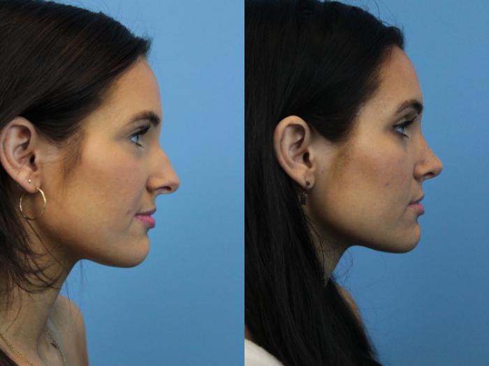 Before & After Rhinoplasty Case 242 Right Side View in West Des Moines & Ames, IA