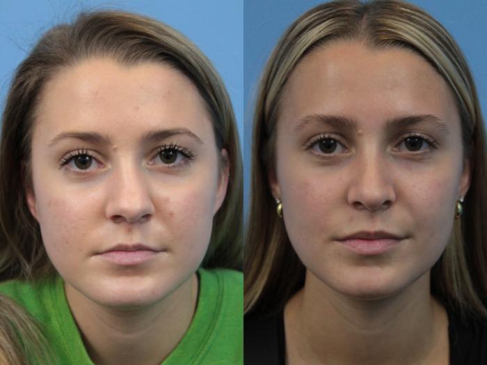 Before & After Rhinoplasty Case 243 Front View in West Des Moines & Ames, IA