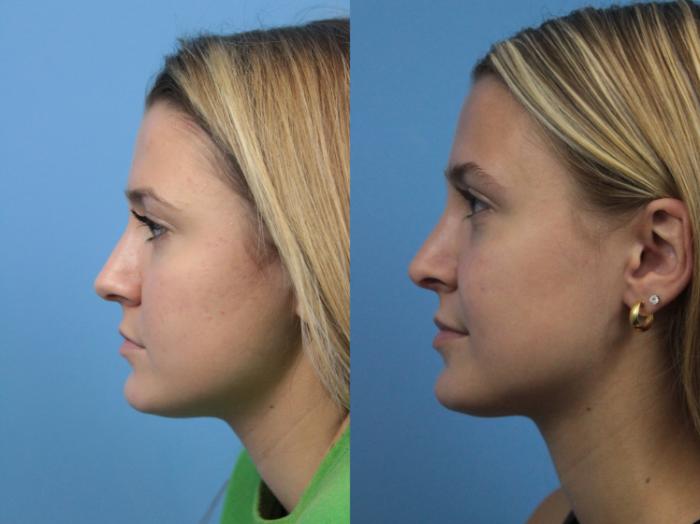 Before & After Rhinoplasty Case 243 Left Side View in West Des Moines & Ames, IA