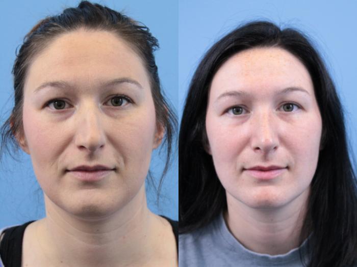 Before & After Rhinoplasty Case 247 Front View in West Des Moines & Ames, IA