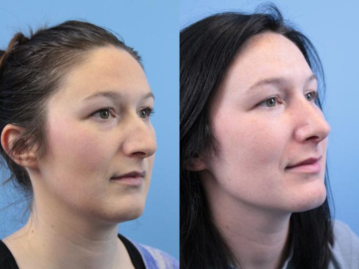 Before & After Rhinoplasty Case 247 Right Oblique View in West Des Moines & Ames, IA
