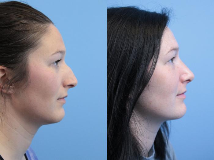 Before & After Rhinoplasty Case 247 Right Side View in West Des Moines & Ames, IA