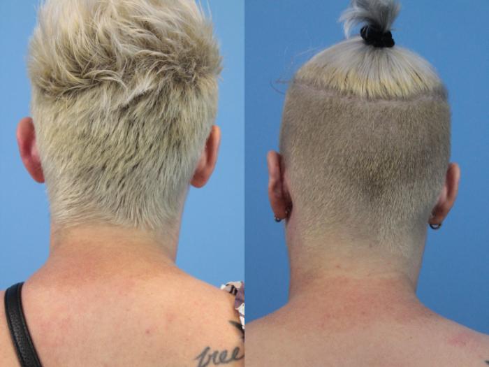 Before & After Rhinoplasty Case 250 Back View in West Des Moines & Ames, IA