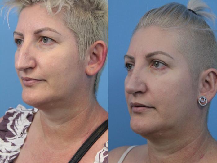 Before & After Rhinoplasty Case 250 Left Oblique View in West Des Moines & Ames, IA