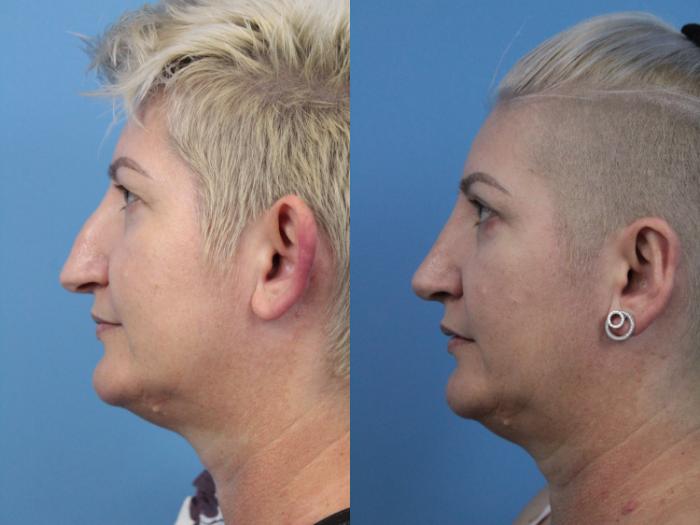 Before & After Rhinoplasty Case 250 Left Side View in West Des Moines & Ames, IA