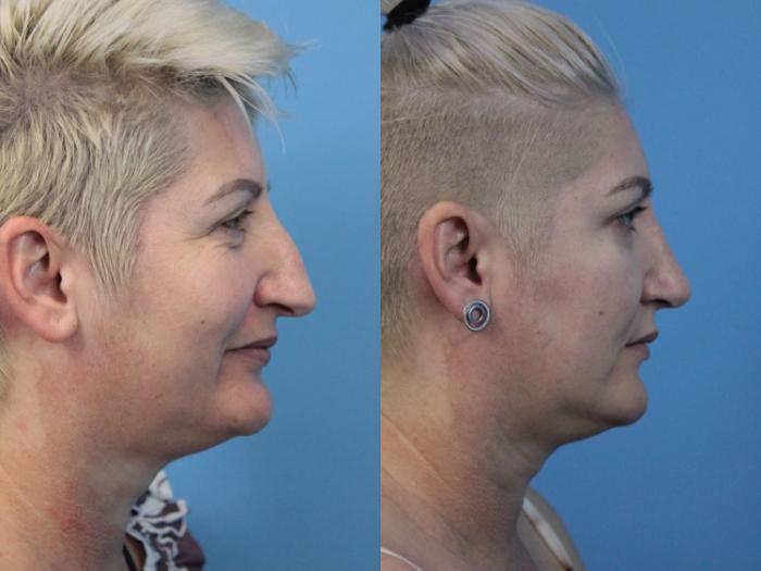 Before & After Rhinoplasty Case 250 Right Side View in West Des Moines & Ames, IA