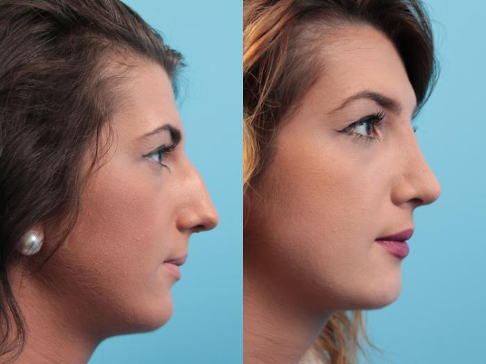 Before & After Rhinoplasty Case 26 View #1 View in West Des Moines & Ames, IA