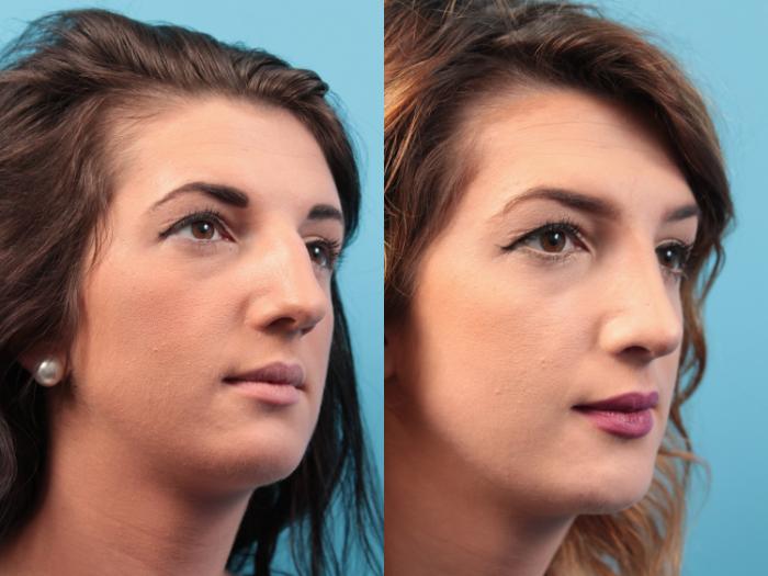 Before & After Rhinoplasty Case 26 View #2 View in West Des Moines & Ames, IA