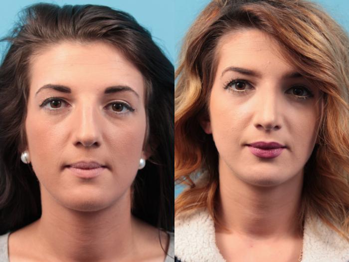Before & After Rhinoplasty Case 26 View #3 View in West Des Moines & Ames, IA
