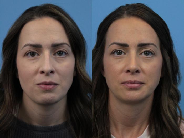 Before & After Rhinoplasty Case 280 Front View in West Des Moines & Ames, IA