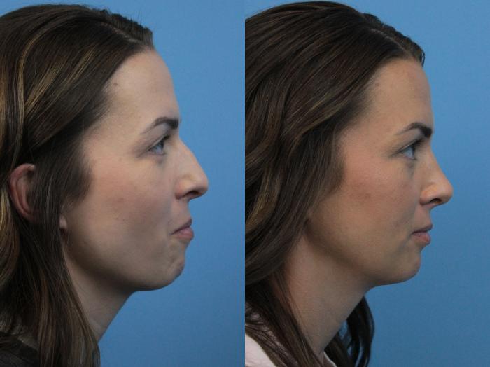 Before & After Rhinoplasty Case 280 Right Side View in West Des Moines & Ames, IA
