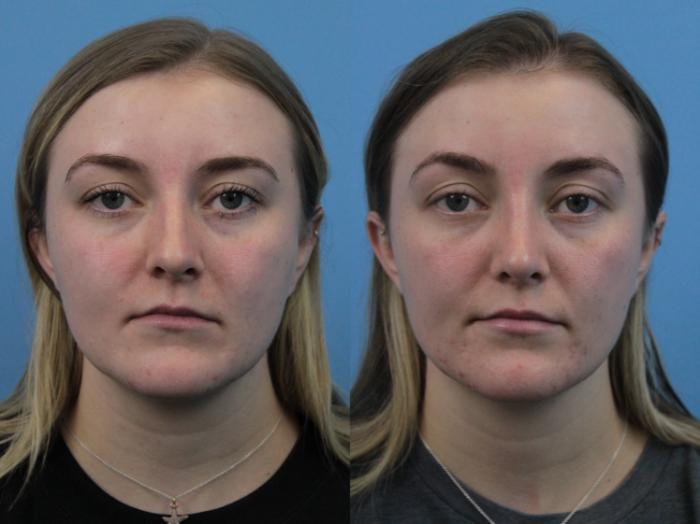 Before & After Rhinoplasty Case 284 Front View in West Des Moines & Ames, IA