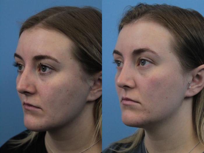 Before & After Rhinoplasty Case 284 Left Oblique View in West Des Moines & Ames, IA
