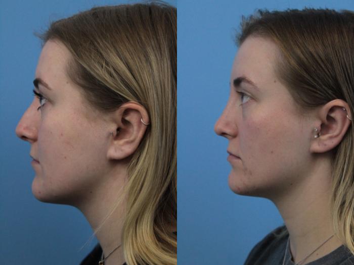 Before & After Rhinoplasty Case 284 Left Side View in West Des Moines & Ames, IA