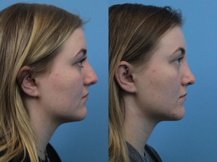 Before & After Rhinoplasty Case 284 Right Side View in West Des Moines & Ames, IA