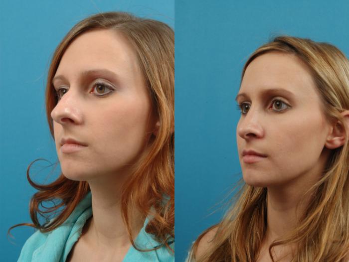 Before & After Rhinoplasty Case 3 View #2 View in West Des Moines & Ames, IA